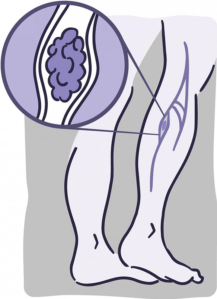 Illustration of the veins in the lower leg and a close-up of a blood clot lodged in a vein Illustration of the veins in the lower leg and a close-up of a blood clot lodged in a vein.