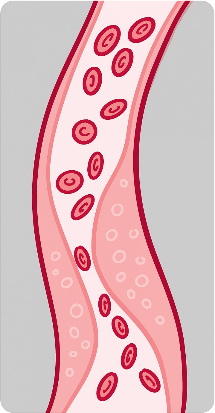 Illustration of a blood vessel with plaque buildup Illustration of a blood vessel with plaque buildup