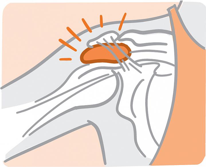 Illustration of a bursa in a shoulder joint Illustration of a bursa in a shoulder joint