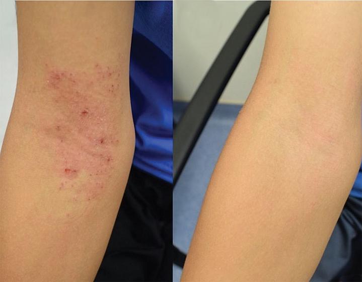 Photos of eczema on a patients elbow before and after experimental treatment