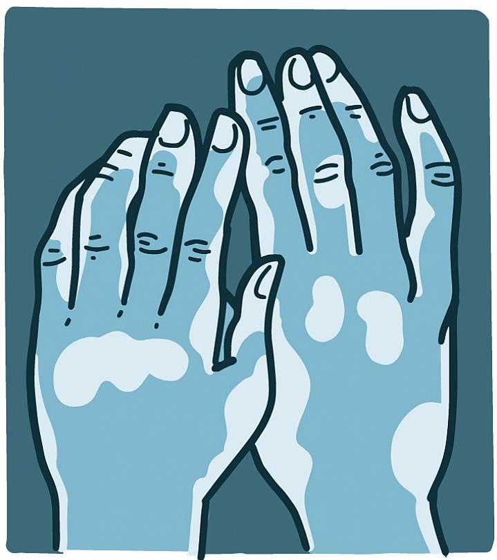 Illustration of hands with patches of vitiligo Illustration of hands with patches of vitiligo