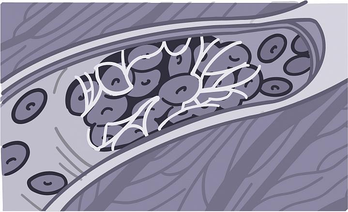 Illustration of a blood clot in a blood vessel Illustration of a blood clot in a blood vessel