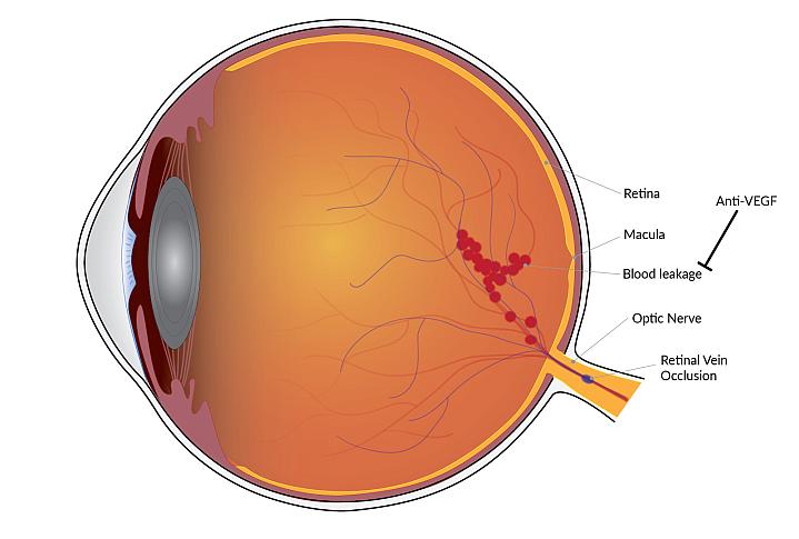 Diagram of an eye with a retinal vein occlusion Diagram of an eye with a retinal vein occlusion