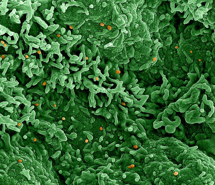 Monkeypox virus (orange) in infected cells